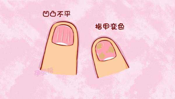 感染了灰指甲怎么办