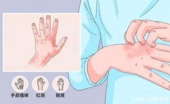 治疗湿疹需要注意什么
