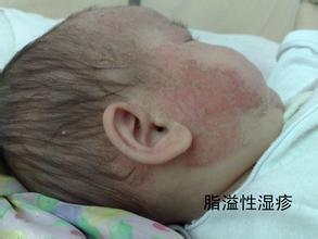 皮肤病患者饮食上要注意什么