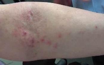 湿疹用药注意事项
