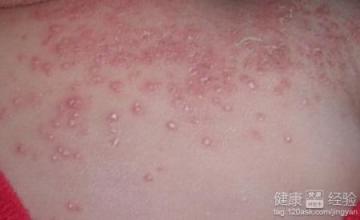 湿疹如何治疗能去根呢